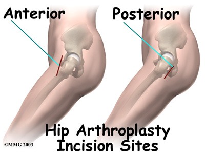 Total Hip Replacement Darlinghurst, NSW