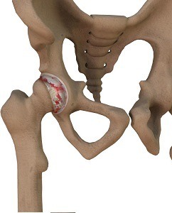 Inflammatory Arthritis of the Hip