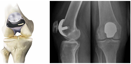 Patellofemoral joint replacement