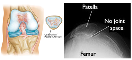 Patellofemoral joint replacement