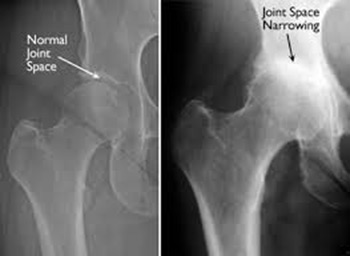 X-ray Osteoarthritis Hip